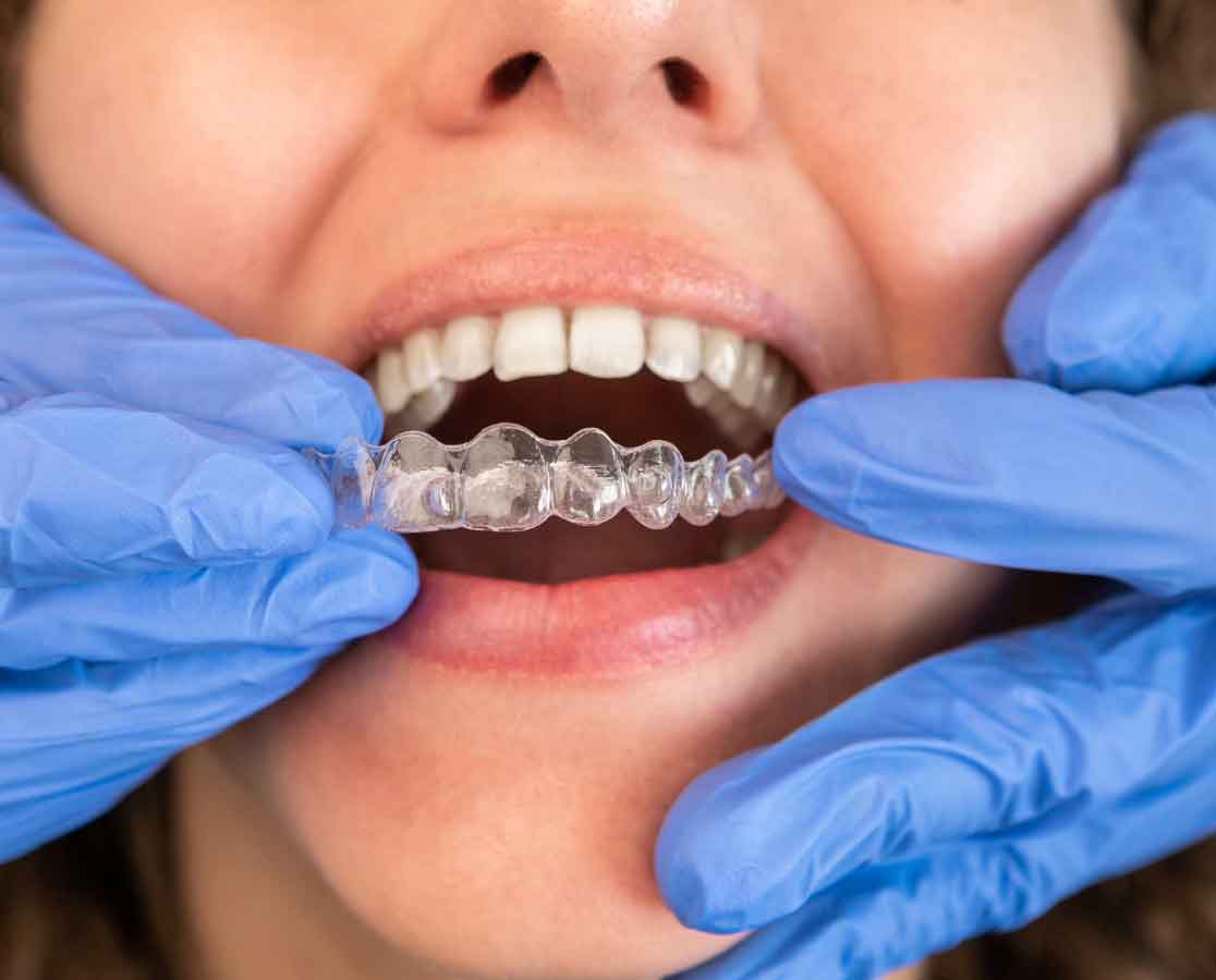 A close-up of a smiling woman having a clear invisalign fitted into her mouth by a dental professional wearing blue gloves