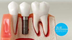 Dental model displaying a titanium dental implant between two molars