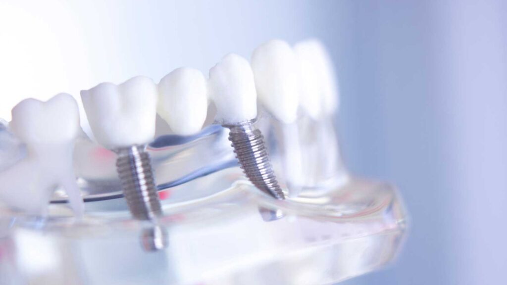 Transparent dental model featuring two dental implants among white teeth