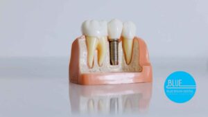 A dental model showing a cross-section of teeth and a dental implant