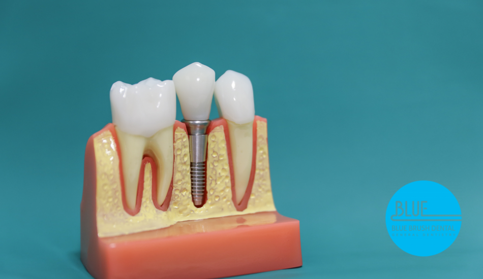 A dental implant model showing a titanium screw fitted between two healthy teeth