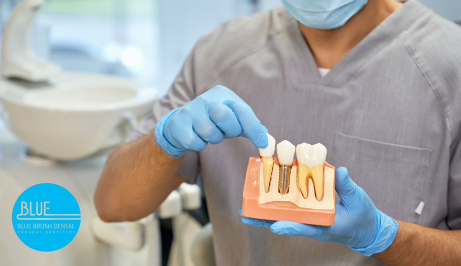 A dentist demonstrates a dental implant model while wearing gloves and a mask