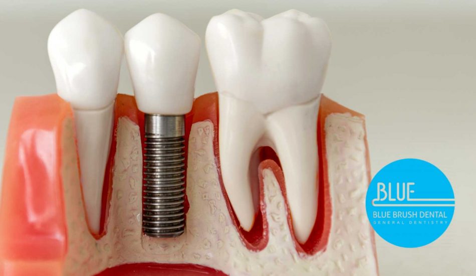 Dental model displaying a titanium dental implant between two molars